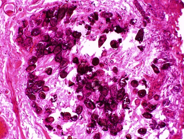 Fig. 6 - Calcificaciones abundatsimas, distribudas por la pared vesical